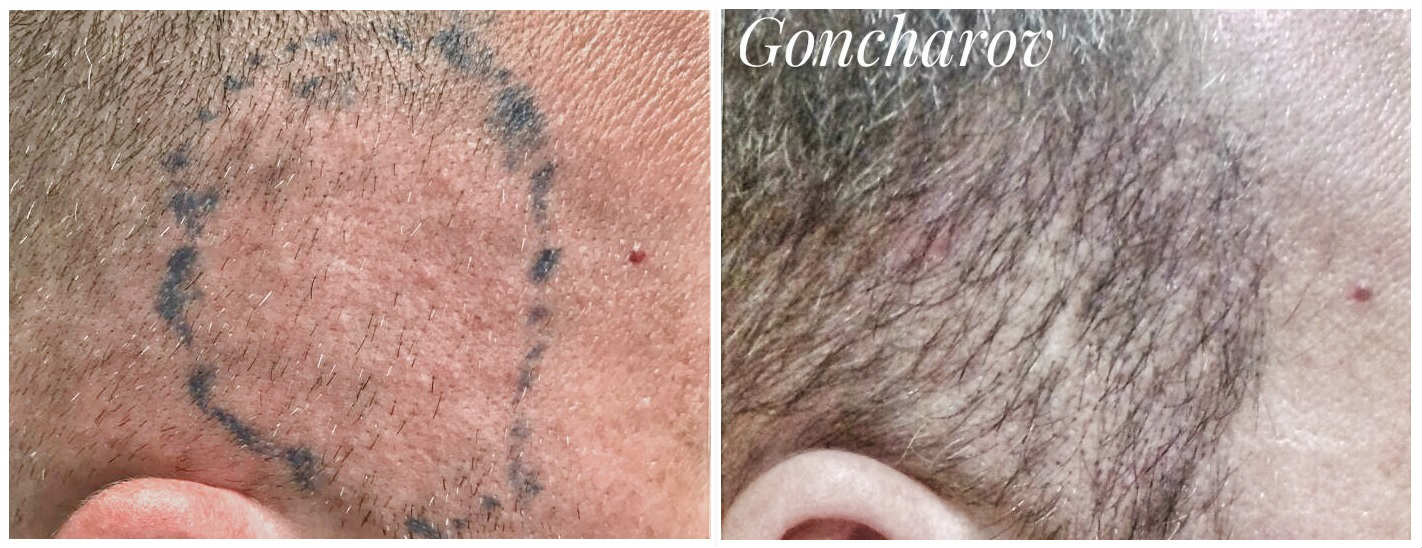 Фото до и после пересадки волос у пластического хирурга Гончарова Александра Петровича
