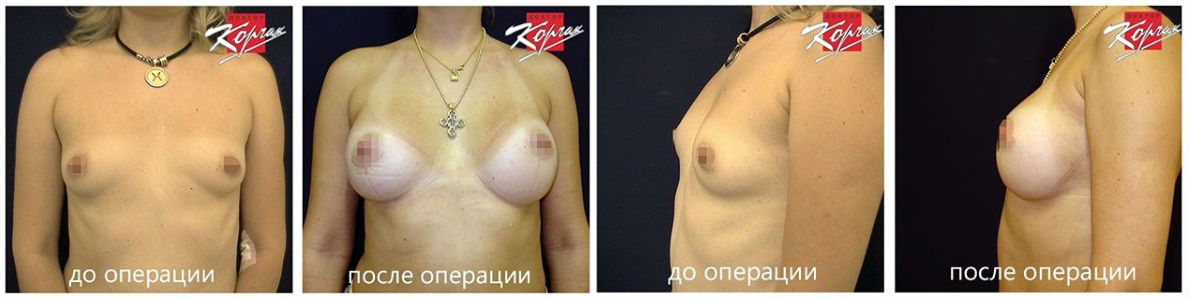 Фото до и после маммопластики у пластического хирурга Корчака Владимира Васильевича