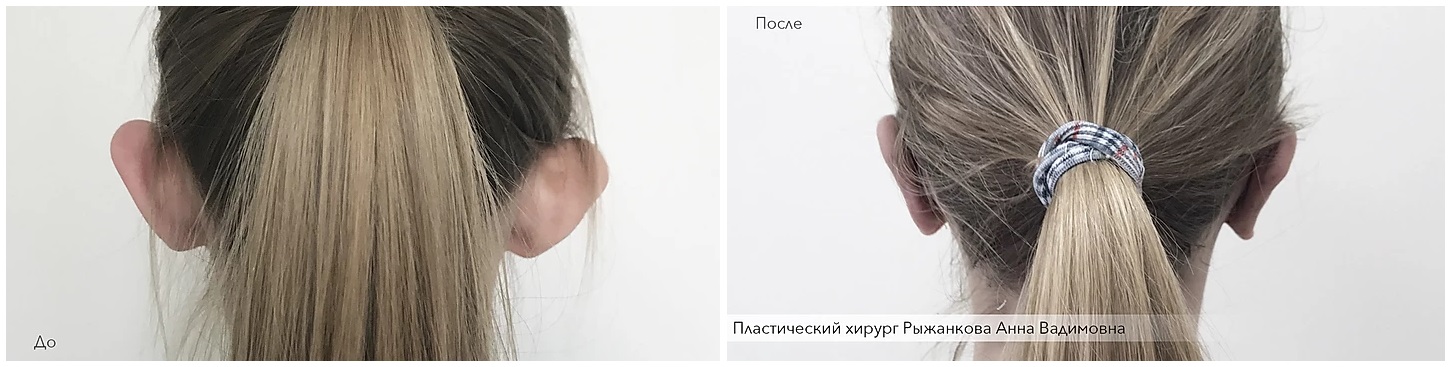 Фото до и после коррекции ушей у пластического хирурга Рыжанковой Анны Вадимовны