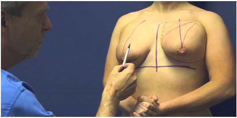 Коррекция тубулярной формы груди с помощью операции